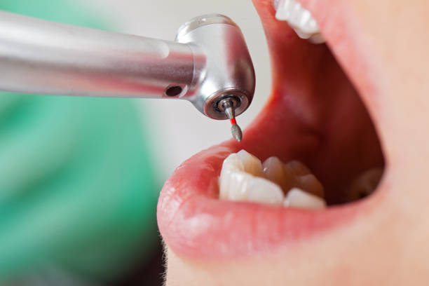 Best Emergency Wisdom Teeth Removal in Ecru, MS
